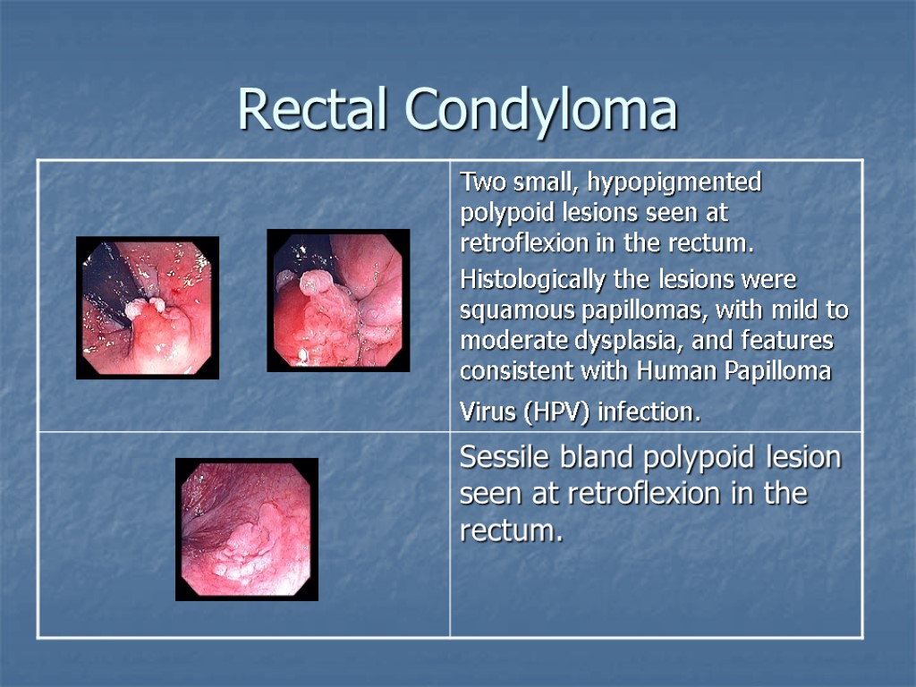 Rectal Condyloma